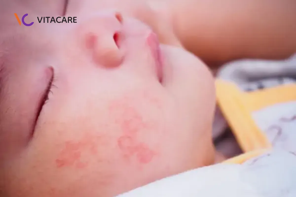 Phát ban, nổi mẩn đỏ, mề đay là một biểu hiện khi trẻ không hợp sữa công thức Phát ban, nổi mẩn đỏ, mề đay là một biểu hiện khi trẻ không hợp sữa công thức