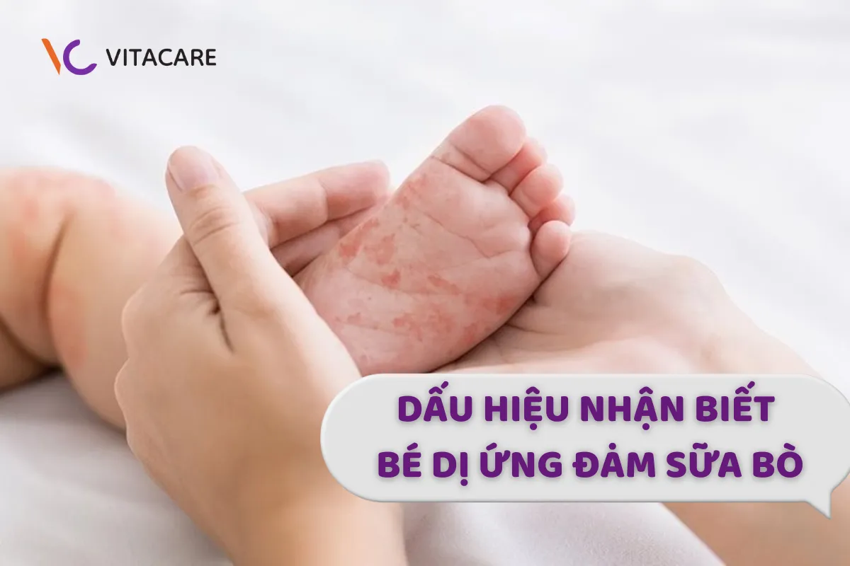 Dấu hiệu nhận biết bé dị ứng đạm sữa bò Dấu hiệu nhận biết bé dị ứng đạm sữa bò