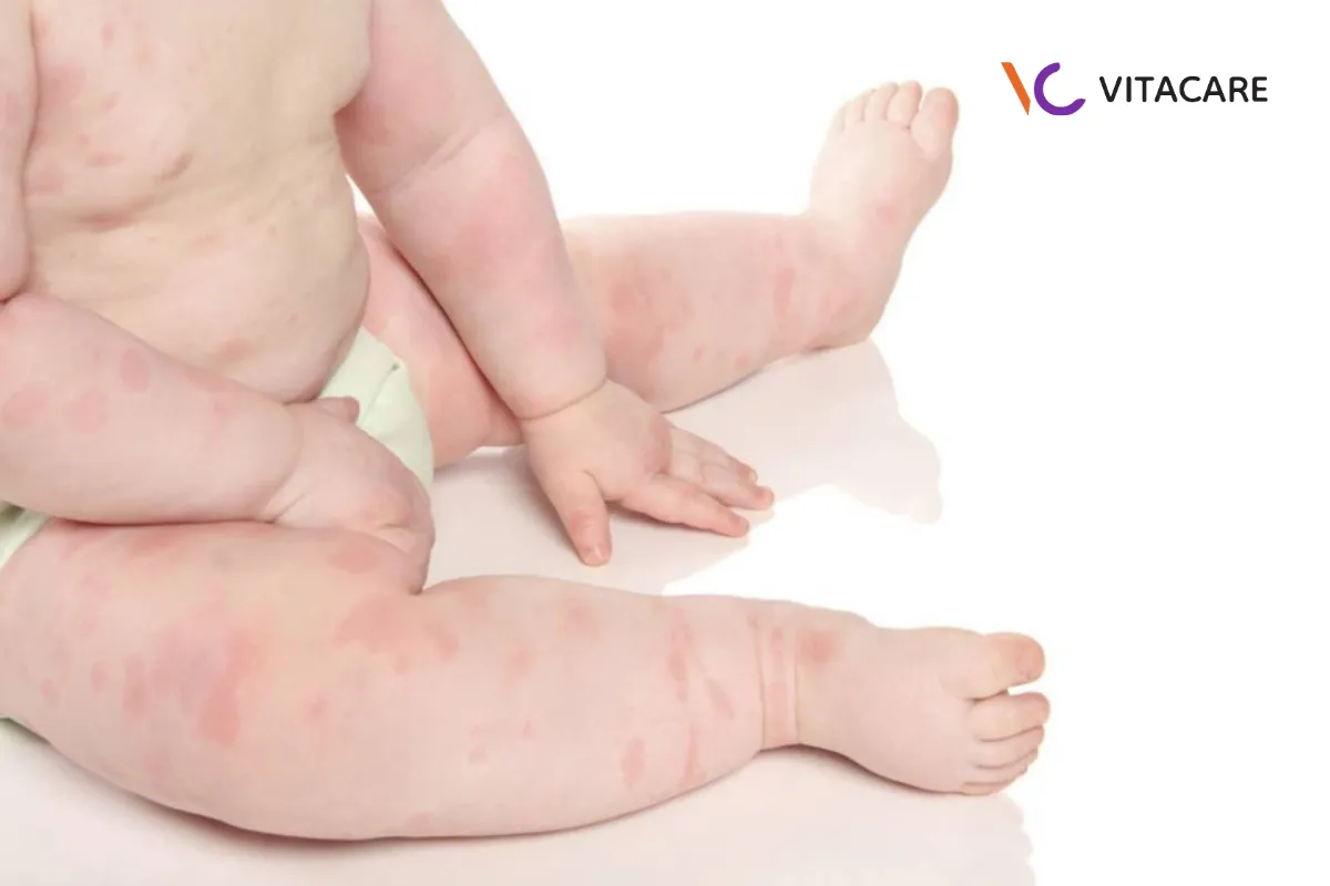 Tăng nguy cơ bị dị ứng đạm sữa bò hoặc đậu nành Tăng nguy cơ bị dị ứng đạm sữa bò hoặc đậu nành