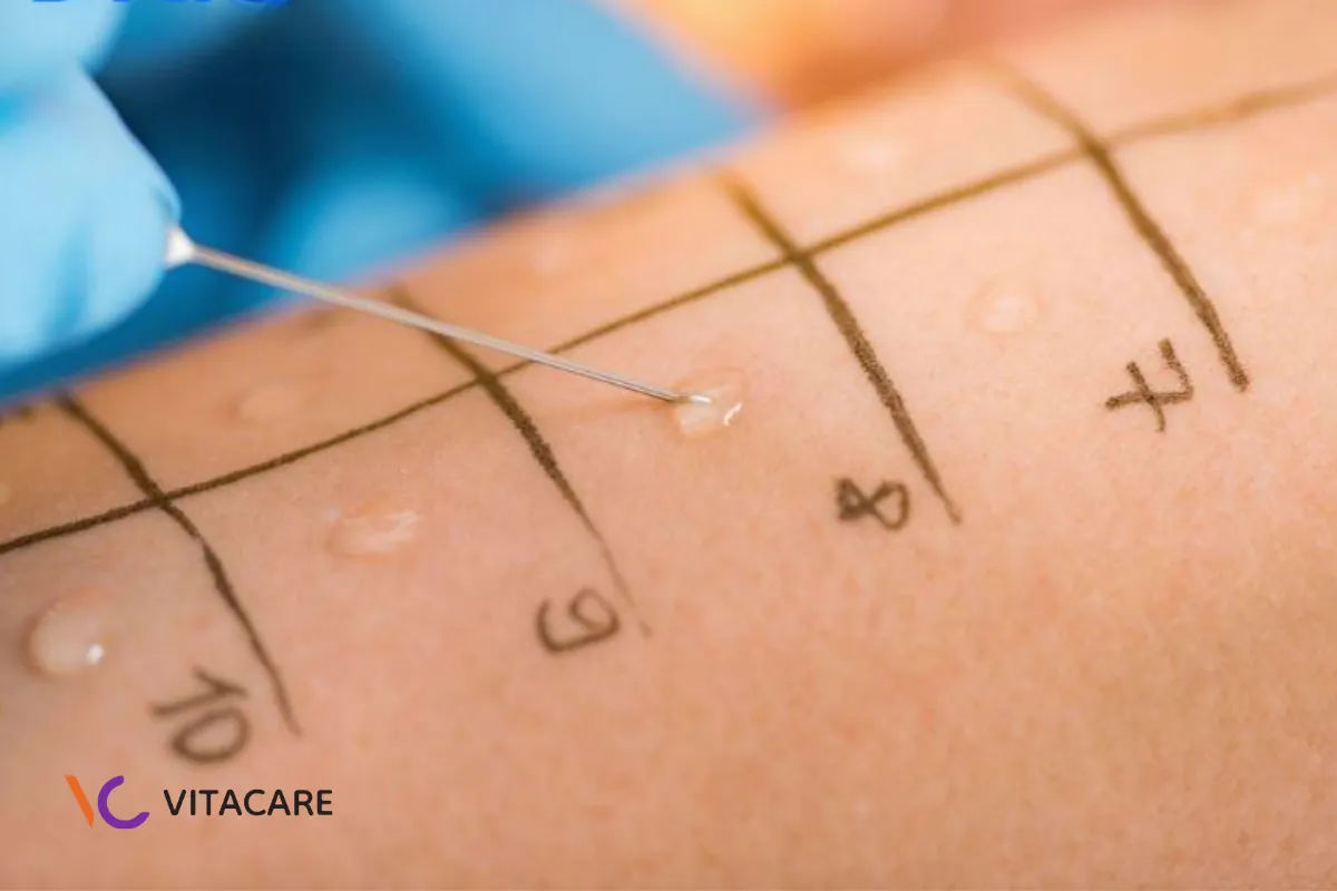 Lấy mẫu da (skin prick test) với sữa bò Lấy mẫu da (skin prick test) với sữa bò