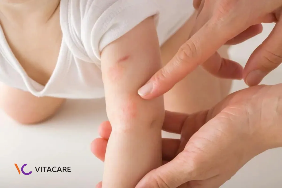 Chỉ sử dụng sữa dê khi có hướng dẫn và giám sát từ bác sĩ dị ứng nhi khoa