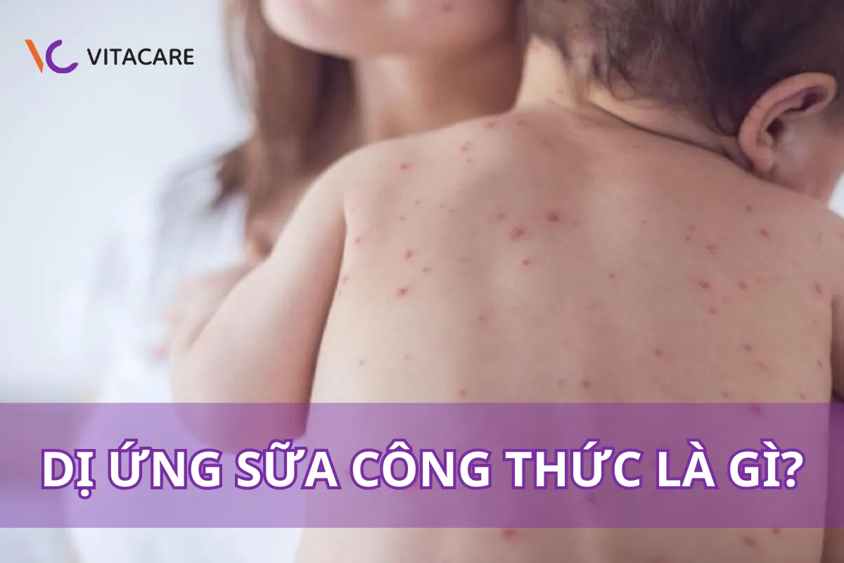 Dị ứng sữa công thức là gì?