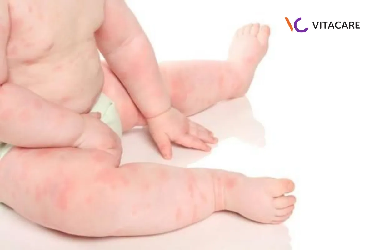 Dị ứng sữa công thức biểu hiện trên da