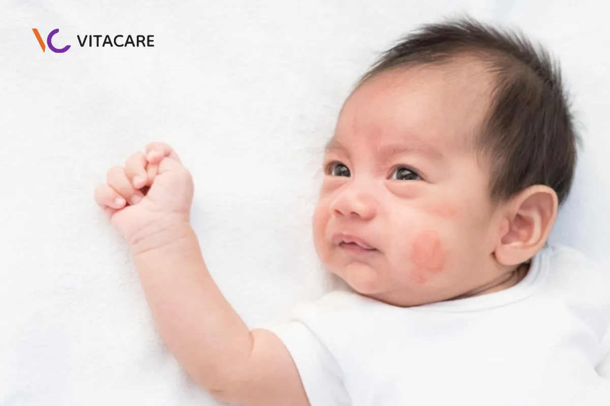Bé cơ địa nhạy cảm và hệ miễn dịch chưa hoàn thiện dễ bị dị ứng 