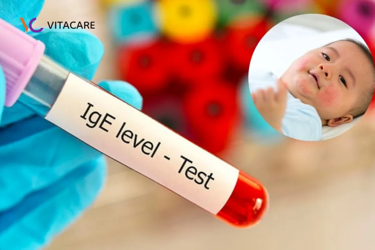 Nên cho bé làm các xét nghiệm như test lẩy da IgE để xác định chính xác